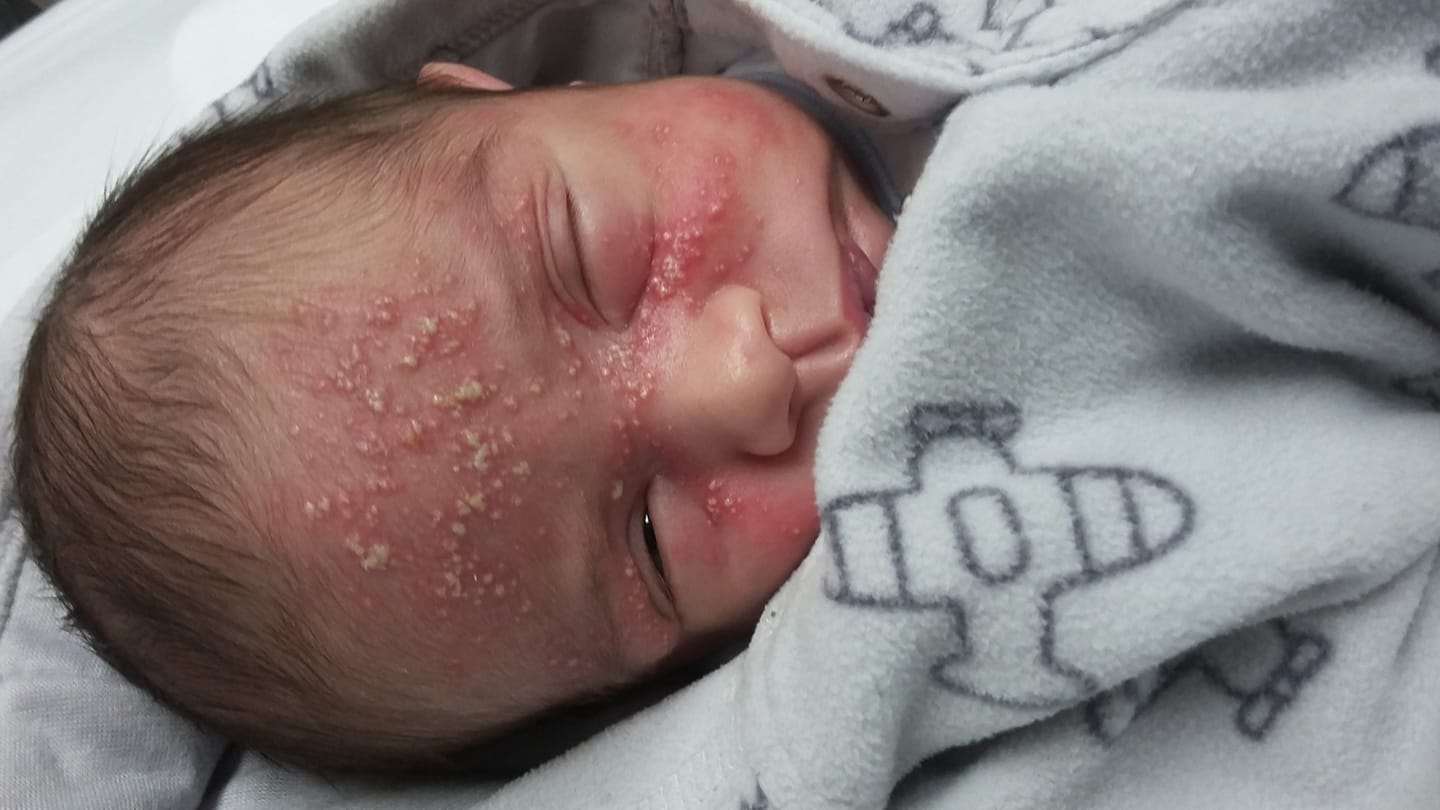 What You Must Know About Herpes Simplex Infection And Babies