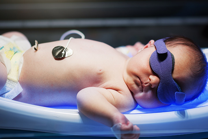 newborn-jaundice-causes-symptoms-treatment-and-prevention